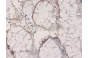 Immunohistochemistry of paraffin-embedded human colon cancer using ABIN7142468 at dilution of 1:20 (HPD anticorps  (AA 2-393))
