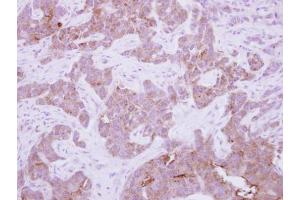 IHC-P Image Immunohistochemical analysis of paraffin-embedded human breast cancer, using CPNE6, antibody at 1:250 dilution. (CPNE6 anticorps)