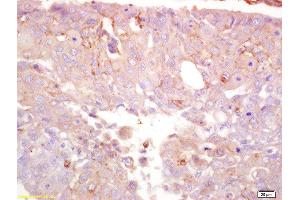 Formalin-fixed and paraffin embedded human lung carcinoma labeled with Anti-TRPM7 Polyclonal Antibody, Unconjugated  at 1:200 followed by conjugation to the secondary antibody and DAB staining (TRPM7 anticorps  (AA 800-850))