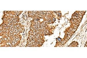 Immunohistochemistry of paraffin-embedded Human colorectal cancer tissue using ATP5I Polyclonal Antibody at dilution of 1:65(x200)