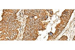 Immunohistochemistry of paraffin-embedded Human colorectal cancer tissue using ATP5I Polyclonal Antibody at dilution of 1:65(x200)