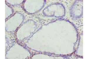 Immunohistochemistry of paraffin-embedded human colon cancer using ABIN7153655 at dilution of 1:100 (MLZE anticorps  (AA 1-508))