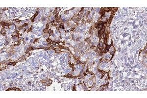 ABIN6276996 at 1/100 staining Human urothelial cancer tissue by IHC-P. (ACVR2A anticorps  (Internal Region))