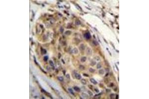 Formalin fixed, paraffin embedded human breast carcinoma stained with SSH3 Antibody (C-term) followed wihc was peroxidase conjugated to the secondary antibody and followed by DAB staining.