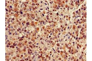 Immunohistochemistry of paraffin-embedded human glioma using ABIN7147705 at dilution of 1:100