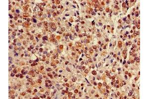 Immunohistochemistry of paraffin-embedded human glioma using ABIN7147705 at dilution of 1:100 (CBX5 anticorps  (AA 1-191))