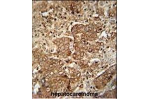 CS antibody (C-term) 10677b immunohistochemistry analysis in formalin fixed and paraffin embedded human hepatocarcinoma followed by peroxidase conjugation of the secondary antibody and DAB staining. (APCS anticorps  (C-Term))