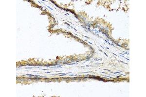 Immunohistochemistry of paraffin-embedded Human prostate using SOST Polyclonal Antibody at dilution of 1:100 (40x lens). (Sclerostin anticorps)