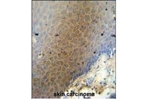 CEP70 antibody (Center) (ABIN654603 and ABIN2844302) immunohistochemistry analysis in formalin fixed and paraffin embedded human skin carcinoma followed by peroxidase conjugation of the secondary antibody and DAB staining. (CEP70 anticorps  (AA 309-338))
