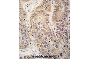 Formalin-fixed and paraffin-embedded human hepatocarcinomareacted with HARS polyclonal antibody , which was peroxidase-conjugated to the secondary antibody, followed by AEC staining. (HARS1/Jo-1 anticorps  (N-Term))