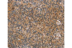 Immunohistochemistry of Human cervical cancer using TAC1 Polyclonal Antibody at dilution of 1:25 (TAC1 anticorps)