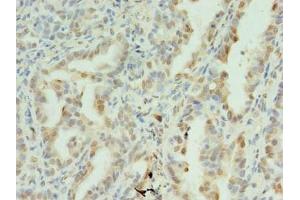 Immunohistochemistry of paraffin-embedded human lung cancer using ABIN7170902 at dilution of 1:100