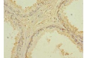 Immunohistochemistry of paraffin-embedded human prostate cancer using ABIN7147148 at dilution of 1:100 (CD276 anticorps  (AA 29-200))