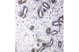 Anti-TRIF antibody, IHC(P) IHC(P): Human Mammary Cancer Tissue