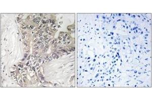 Immunohistochemistry analysis of paraffin-embedded human liver carcinoma tissue, using B3GALTL Antibody. (B3GALTL anticorps  (AA 449-498))