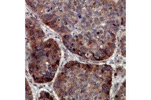 Immunohistochemical analysis of TRAPPC5 staining in human lung cancer formalin fixed paraffin embedded tissue section. (TRAPPC5 anticorps)