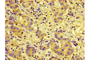 Immunohistochemistry of paraffin-embedded human liver cancer using ABIN7146111 at dilution of 1:100