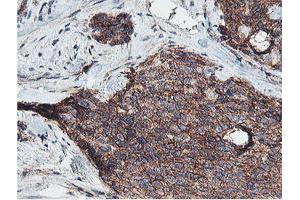 Immunohistochemical staining of paraffin-embedded Adenocarcinoma of Human breast tissue using anti-NPTN mouse monoclonal antibody. (NPTN anticorps)