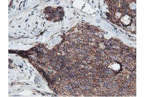 Immunohistochemical staining of paraffin-embedded Adenocarcinoma of Human breast tissue using anti-NPTN mouse monoclonal antibody.