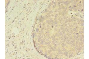 Immunohistochemistry of paraffin-embedded human gastric cancer using ABIN7144805 at dilution of 1:100 (ATXN7L3 anticorps  (AA 51-347))
