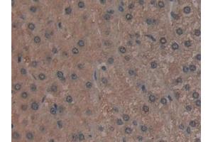 Detection of GLG1 in Human Liver cancer Tissue using Polyclonal Antibody to Golgi Glycoprotein 1 (GLG1)