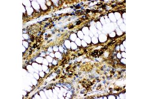 Anti- p73 antibody, IHC(P) IHC(P): Human Intestinal Cancer Tissue