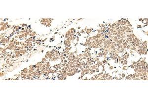 Immunohistochemistry of paraffin-embedded Human lung cancer tissue using GPR139 Polyclonal Antibody at dilution of 1:50(x200) (GPR139 anticorps)