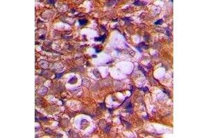 Immunohistochemical analysis of PTEN staining in human prostate cancer formalin fixed paraffin embedded tissue section. (PTEN anticorps  (C-Term))