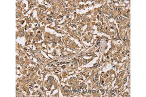 Immunohistochemistry of Human liver cancer using PPP1CC Polyclonal Antibody at dilution of 1:40 (PPP1CC anticorps)