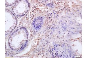 Formalin-fixed and paraffin embedded human colon carcinoma labeled with Anti-IRF3 Polyclonal Antibody, Unconjugated (ABIN682588) at 1:200 followed by conjugation to the secondary antibody and DAB staining