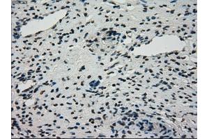 Immunohistochemical staining of paraffin-embedded Adenocarcinoma of breast tissue using anti-STK39 mouse monoclonal antibody. (STK39 anticorps)