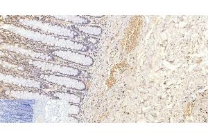 Immunohistochemistry of paraffin-embedded Human colon tissue using Phospho-Pan-Akt (Ser473) Polyclonal Antibody at dilution of 1:200 (AKT1 anticorps  (pSer473))