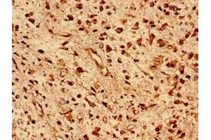 Immunohistochemistry analysis of human glioma using ABIN7150524 at dilution of 1:100 (DNAJB5 anticorps  (AA 1-344))