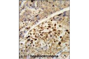 Formalin-fixed and paraffin-embedded human hepatocarcinoma reacted with NR1I2 Antibody (Center), which was peroxidase-conjugated to the secondary antibody, followed by DAB staining.