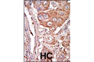 Formalin-fixed and paraffin-embedded human cancer tissue reacted with the primary antibody, which was peroxidase-conjugated to the secondary antibody, followed by DAB staining.