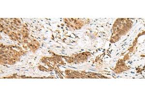 Immunohistochemistry of paraffin-embedded Human esophagus cancer tissue using NUP58 Polyclonal Antibody at dilution of 1:50(x200) (NUPL1 anticorps)