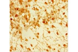 Immunohistochemistry of paraffin-embedded human melanoma using ABIN7160242 at dilution of 1:100 (SMAD5 anticorps  (AA 1-209))