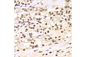 Immunohistochemistry of paraffin-embedded human kidney cancer using ULK4 antibody (ABIN5975557) at dilution of 1/100 (40x lens). (ULK4 anticorps)