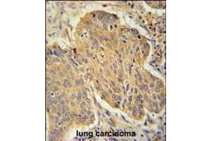 PSMD7 Antibody immunohistochemistry analysis in formalin fixed and paraffin embedded human lung carcinoma followed by peroxidase conjugation of the secondary antibody and DAB staining.
