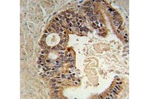 DYRK1A Antiboty immunohistochemistry analysis in formalin fixed and paraffin embedded human prostate carcinoma.