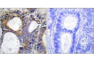 Immunohistochemistry analysis of paraffin-embedded human colon carcinoma tissue, using Collagen I alpha2 Antibody. (COL1A2 anticorps  (AA 471-520))