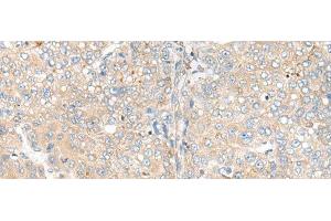 Immunohistochemistry of paraffin-embedded Human liver cancer tissue using CAMK2A Polyclonal Antibody at dilution of 1:55(x200) (CAMK2A anticorps)