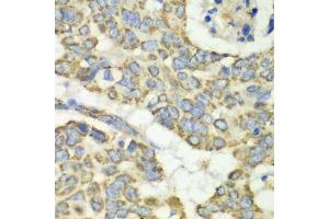 Immunohistochemistry of paraffin-embedded human esophageal cancer using TUFM antibody. (TUFM anticorps  (AA 186-455))