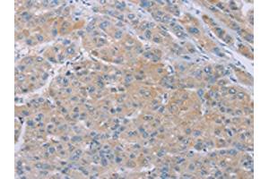The image on the left is immunohistochemistry of paraffin-embedded Human liver cancer tissue using ABIN7192258(SAMD4B Antibody) at dilution 1/20, on the right is treated with synthetic peptide. (SAMD4B anticorps)