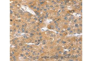 Immunohistochemistry of Human breast cancer using SORT1 Polyclonal Antibody at dilution of 1:40 (Sortilin 1 anticorps)