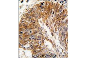 Formalin-fixed and paraffin-embedded human lung carcinoma tissue reacted with PSMD11 antibody , which was peroxidase-conjugated to the secondary antibody, followed by DAB staining.