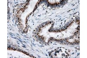 Immunohistochemical staining of paraffin-embedded Adenocarcinoma of colon tissue using anti-LIPG mouse monoclonal antibody. (LIPG anticorps)