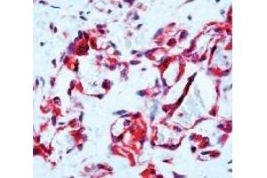 Formalin fixed paraffin embedded human angiosarcoma stained with Flt-1 antibody (FLT1 anticorps  (C-Term))