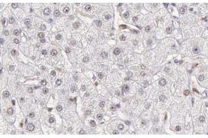 ABIN6266502 at 1/200 staining human liver carcinoma tissue sections by IHC-P. (Caspase 10 anticorps)