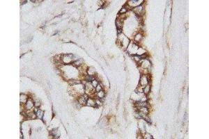 IHC-P: CDC42 antibody testing of human breast cancer tissue (CDC42 anticorps  (Middle Region))
